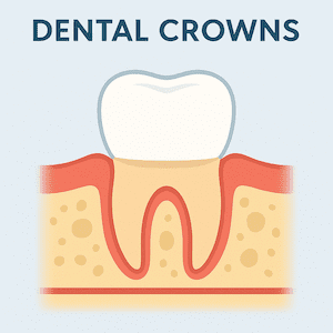Dental Crowns & Same-Day Crowns in Guelph, ON