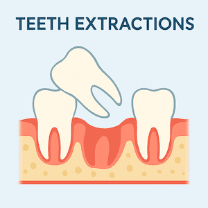 Teeth Extractions in Guelph Teeth Extractions in Guelph