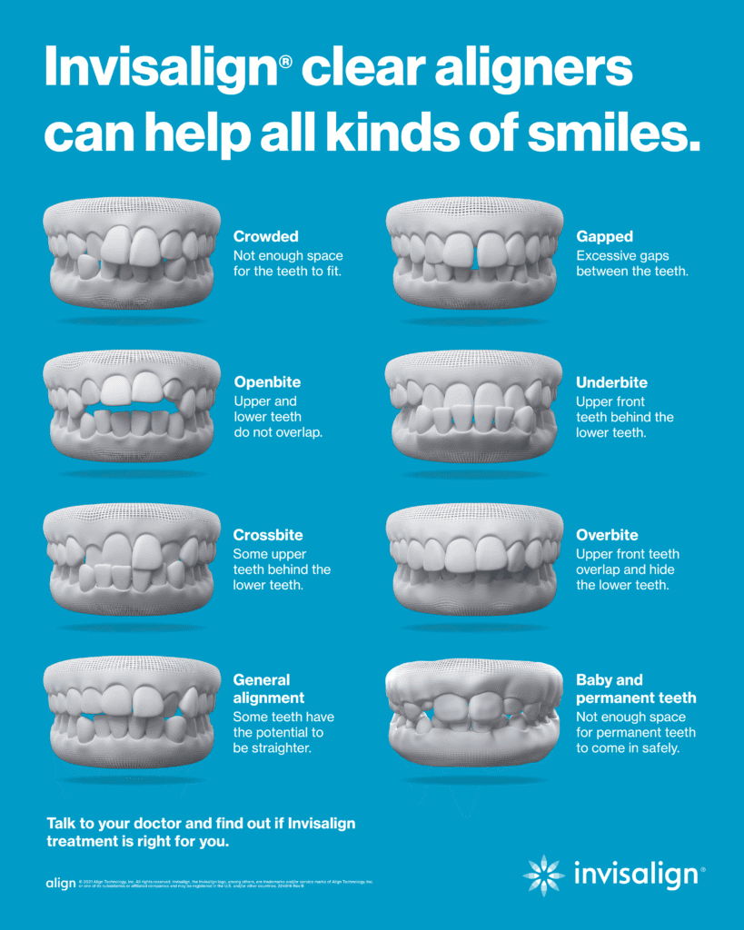What Can Invisalign Fix in Gueplh