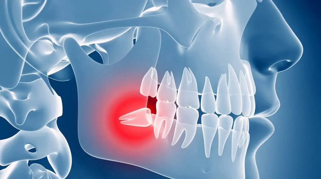 Wisdom Teeth Extraction Experts in Guelph