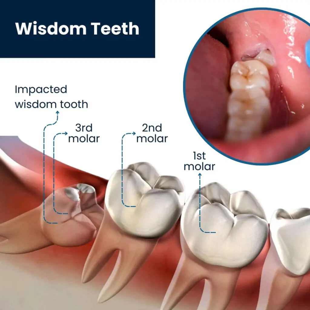 Wisdom Teeth Removal in Guelph, ON 2 Dentist Guelph Why remove a wisdom tooth
