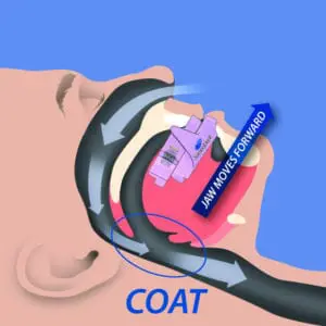 Sleep Apnea Guelph, ON 4 Dentist Guelph How sleep apnea appliance works Guelph