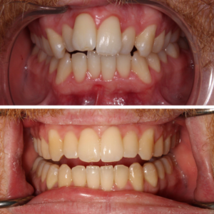 Invisalign Before and After Guelph