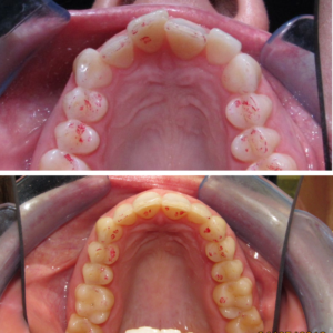 Invisalign Before and After Guelph