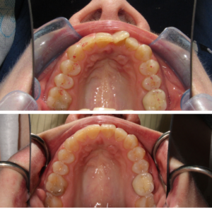 Invisalign Before and After Guelph