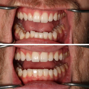 Invisalign Before and After Guelph