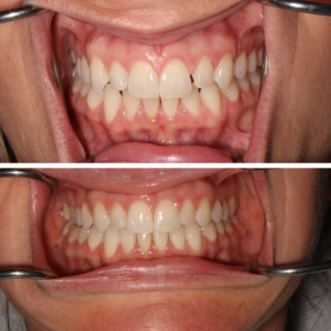 Invisalign Before and After Guelph