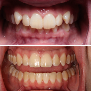 Invisalign Before and After Guelph