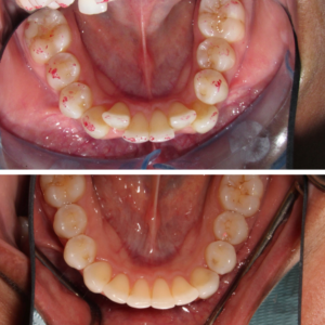 Invisalign Before and After Guelph
