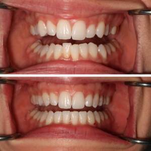 Invisalign Before and After Guelph