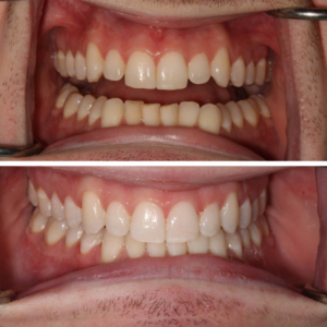 Invisalign Before and After Guelph