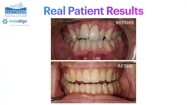Real Guelph Invisalign Before and After Pictures Real Guelph Invisalign Before and After Pictures