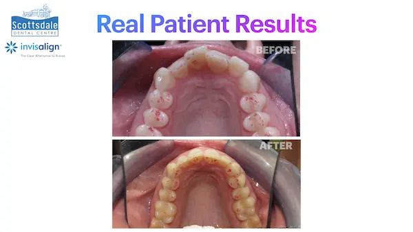Real Guelph Invisalign Before and After Pictures