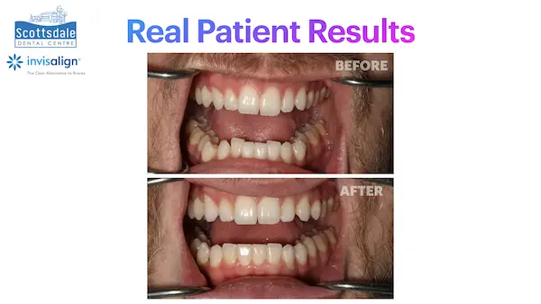 Real Guelph Invisalign Before and After Pictures