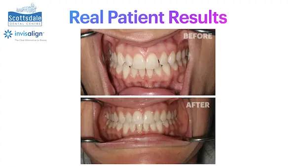 Real Guelph Invisalign Before and After Pictures