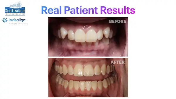 Real Guelph Invisalign Before and After Pictures