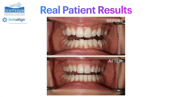 Real Guelph Invisalign Before and After Pictures