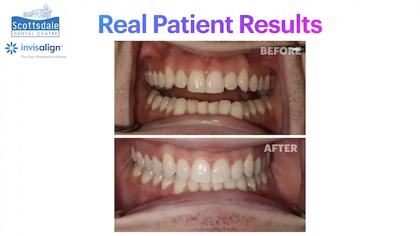 Real Guelph Invisalign Before and After Pictures