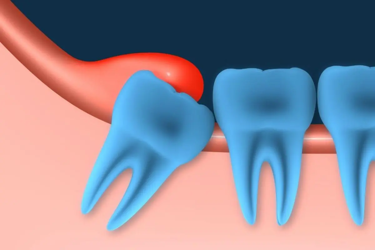 Wisdom Teeth Cost in Guelph