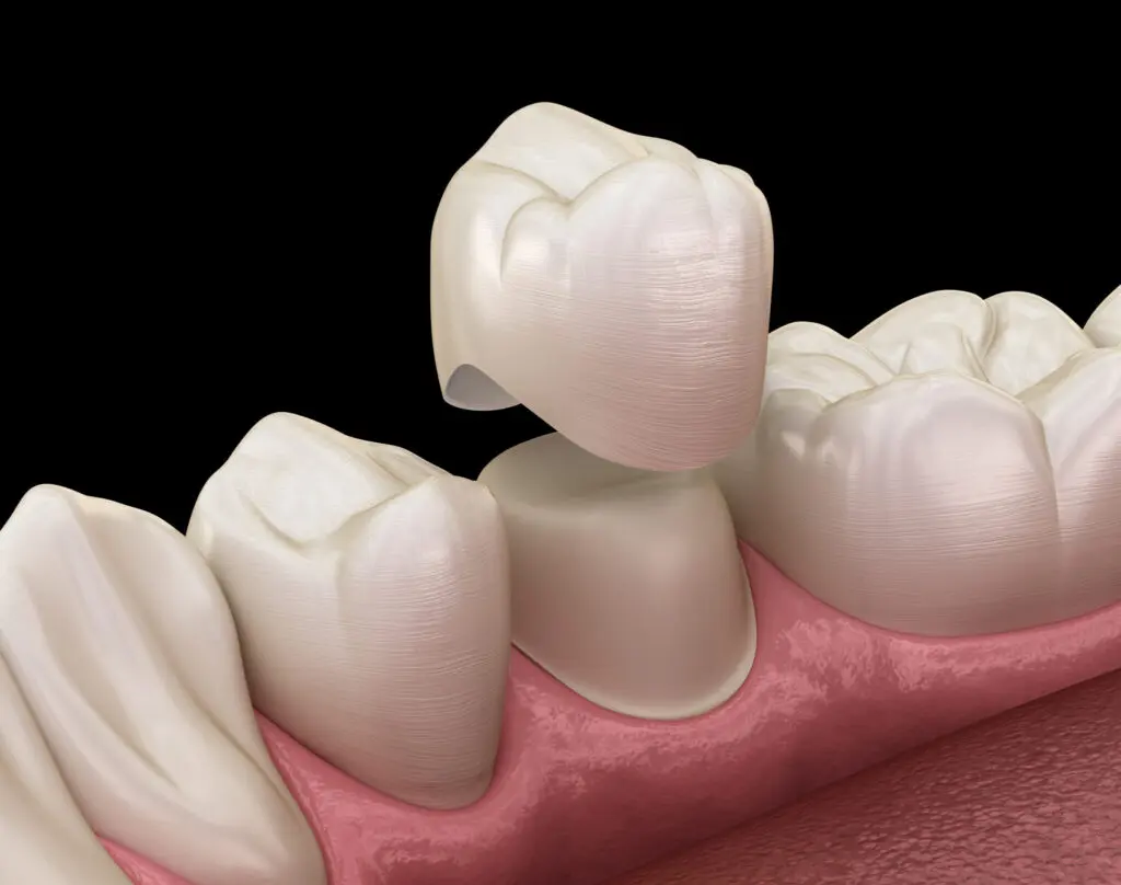 CEREC Crowns Guelph