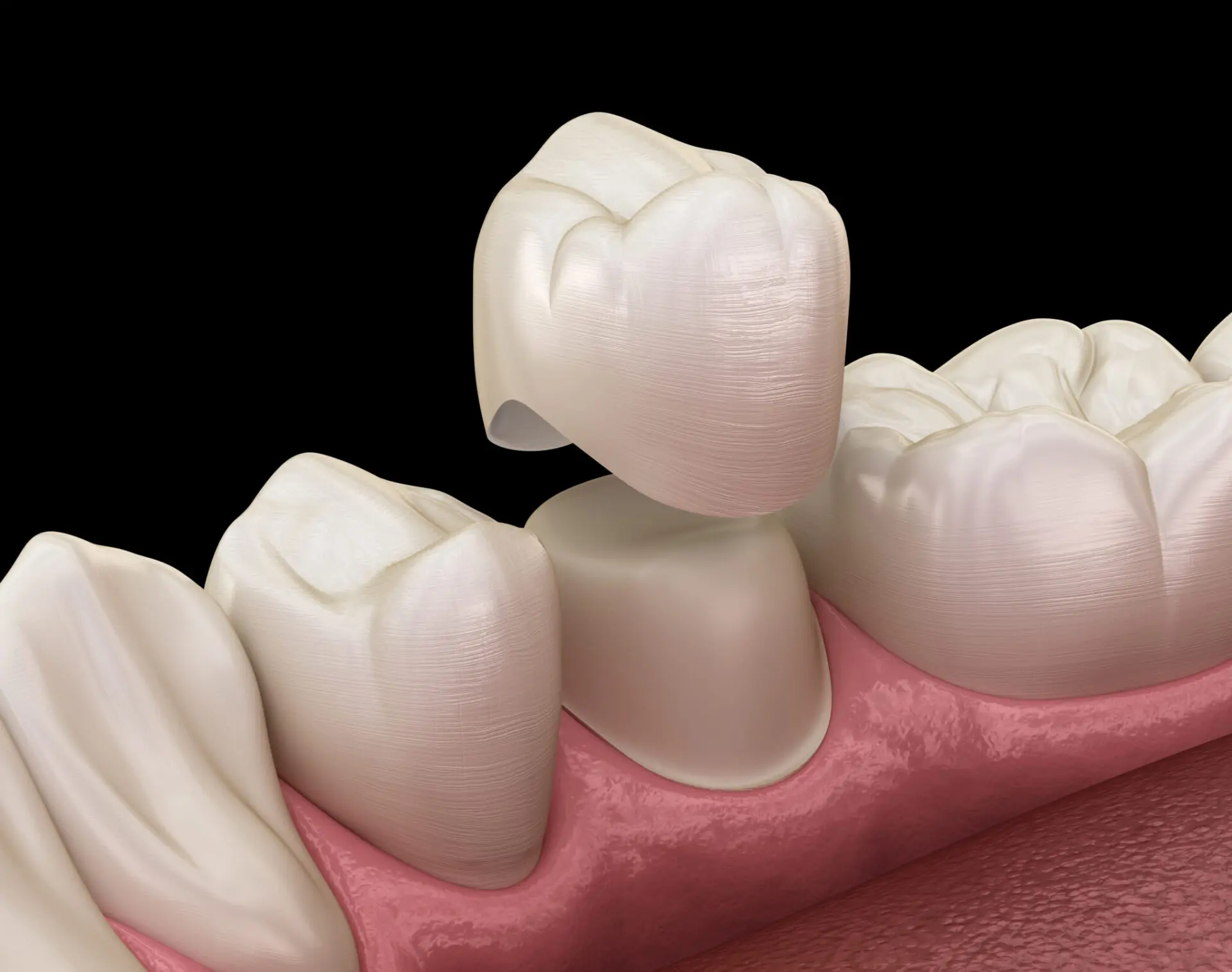 CEREC Crowns Guelph