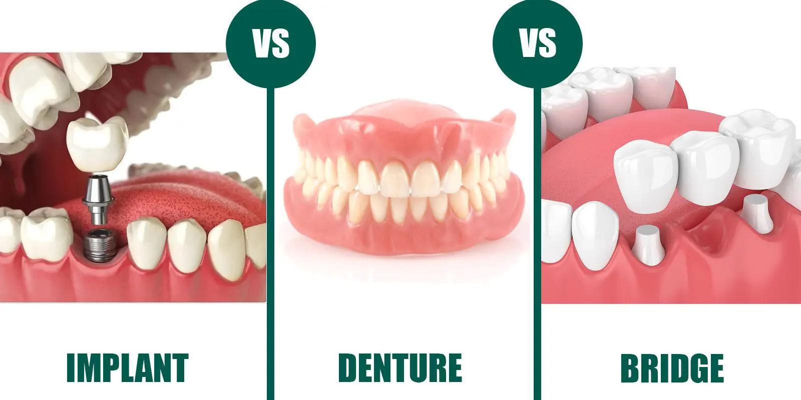 implant vs bridge vs denture in guelph