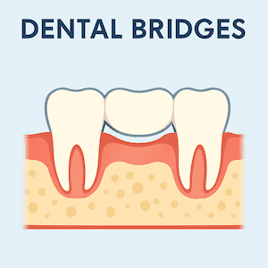 Dental Bridges in Guelph ON Dental Bridges in Guelph ON