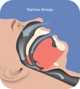 Narrow Airway Snoring Guelph