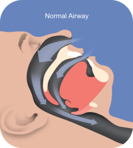 Normal Airway Snoring Guelph